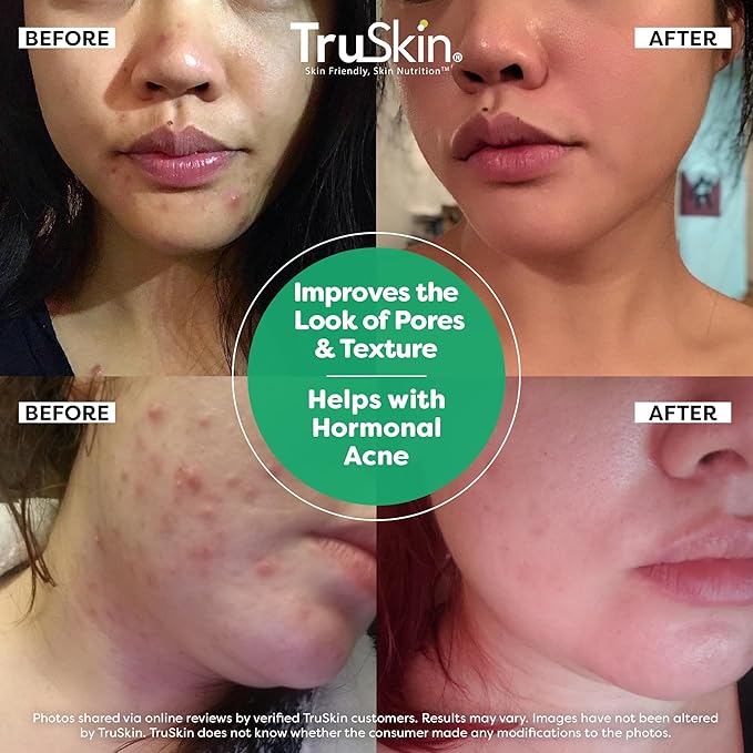 TruSkin Tea Tree Oil Acne Treatment for Face – Acne Serum – Improve the Appearance of Pores, Skin Tone for Smooth, Glowing Skin with Salicylic Acid, Vitamin C, Niacinamide & Retinol, 1 fl oz
